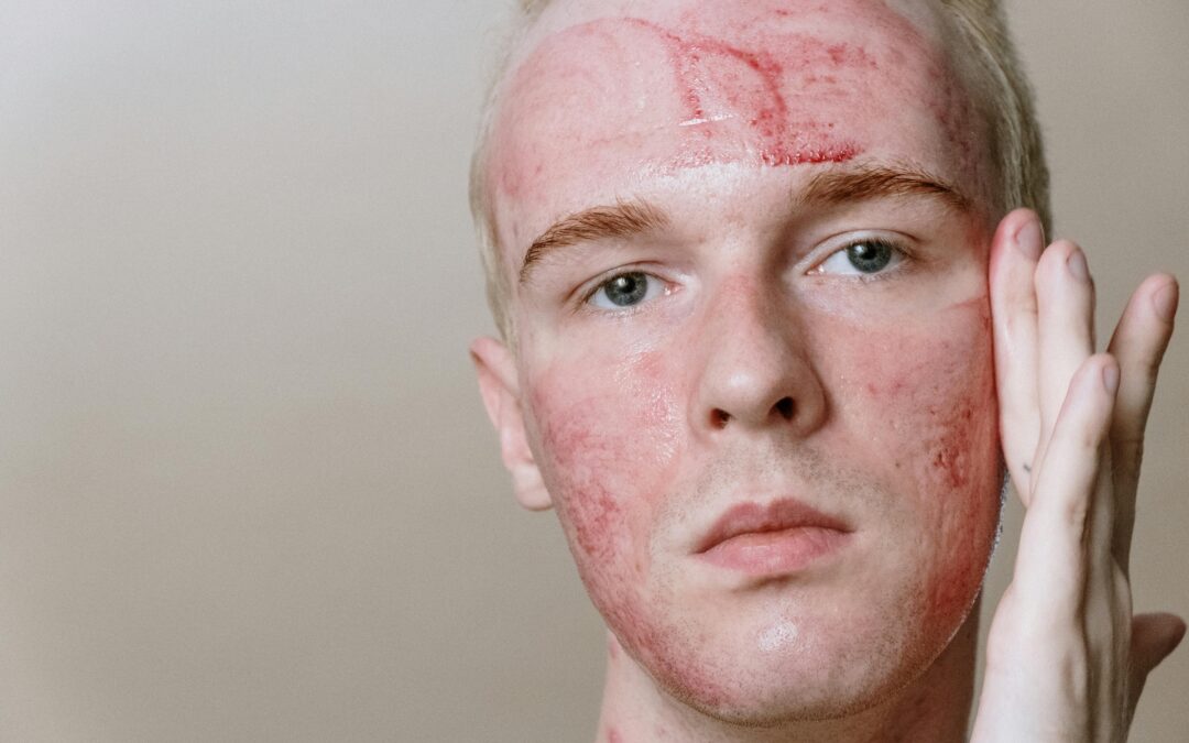 How Quickly Does Clobeta GM Provide Relief From Irritation or Rash?